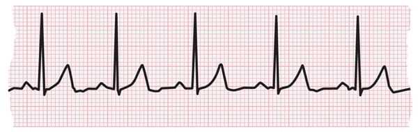 Understanding the Basics of ECG (Electrocardiogram)