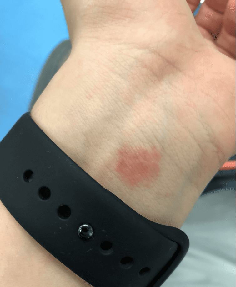 Is Wearing Your Apple Watch 24/7 Safe For Your Skin?