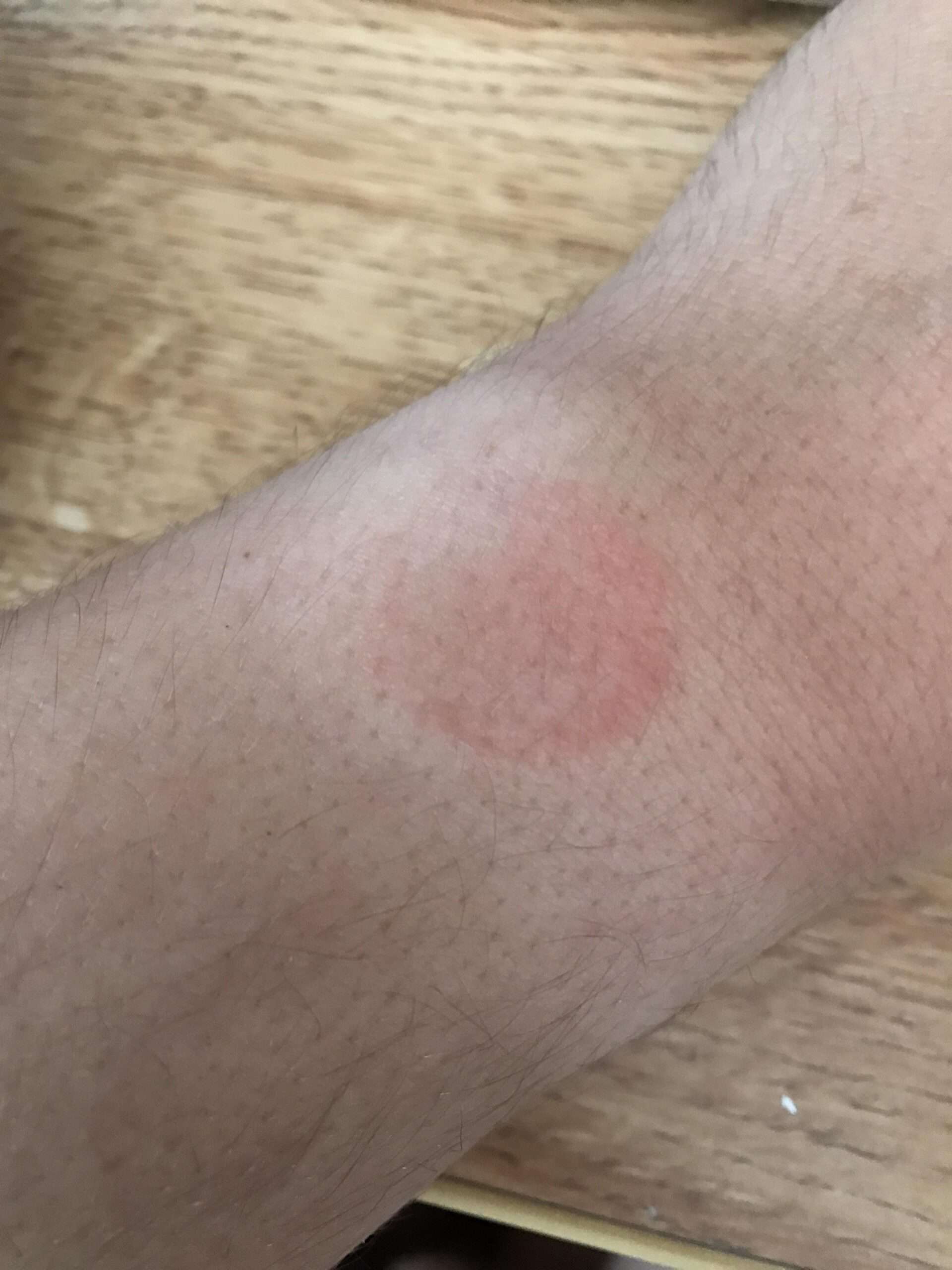 Understanding Allergic Reactions to Apple Watch GadgetMates